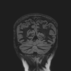 Anterior temporal encephalocele (Radiopaedia 82624-96808 Coronal FLAIR 42).jpg