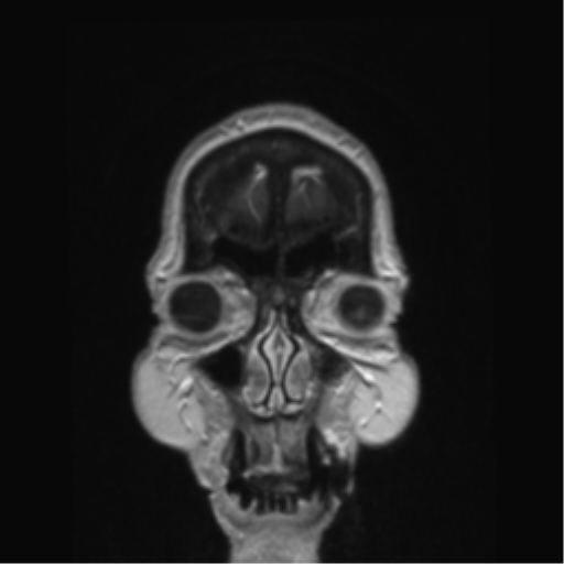 Anterior temporal pole cysts (Radiopaedia 46629-51102 Coronal T1 C+ 165).png