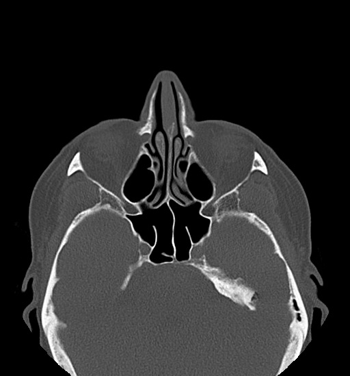 File:Anterior temporomandibular joint dislocation (Radiopaedia 59430-66784 Axial non-contrast 7).jpg