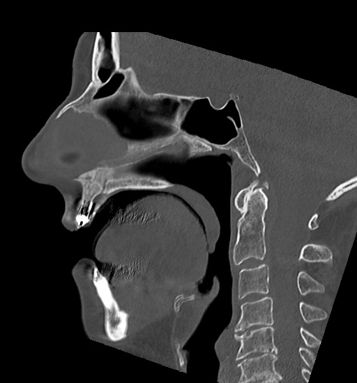 File:Anterior temporomandibular joint dislocation (Radiopaedia 59430-66784 B 31).jpg
