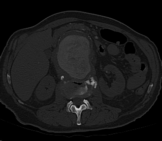 File:Anterior vertebral scalloping (abdominal aortic aneurysm) (Radiopaedia 66744-76067 Axial bone window 12).jpg
