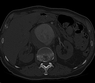 File:Anterior vertebral scalloping (abdominal aortic aneurysm) (Radiopaedia 66744-76067 Axial bone window 27).jpg