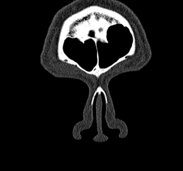 Antrochoanal polyp (Radiopaedia 30002-30554 Coronal bone window 8).jpg