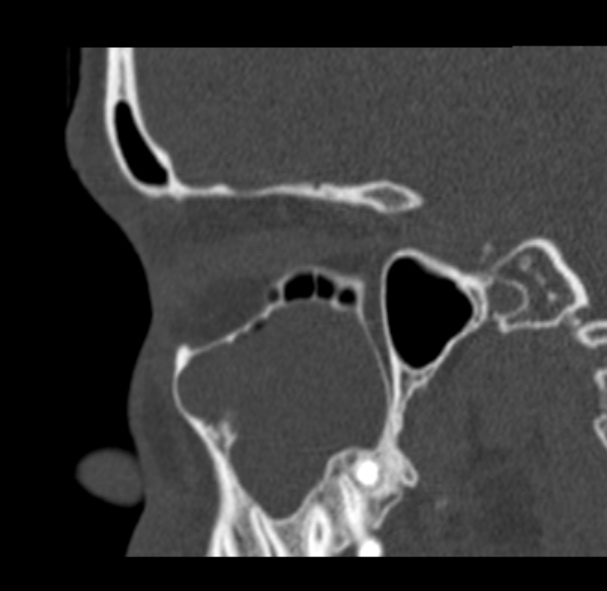 Antrochoanal polyp (Radiopaedia 33984-35202 Sagittal bone window 25).jpg
