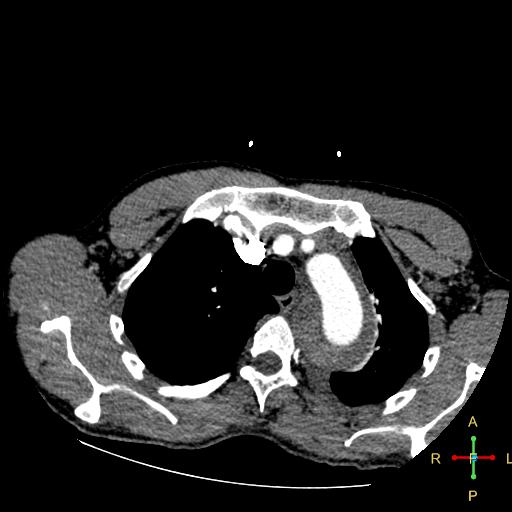 File:Aortic aneurysm and penetrating ulcer (Radiopaedia 23590-23704 A 7).jpg