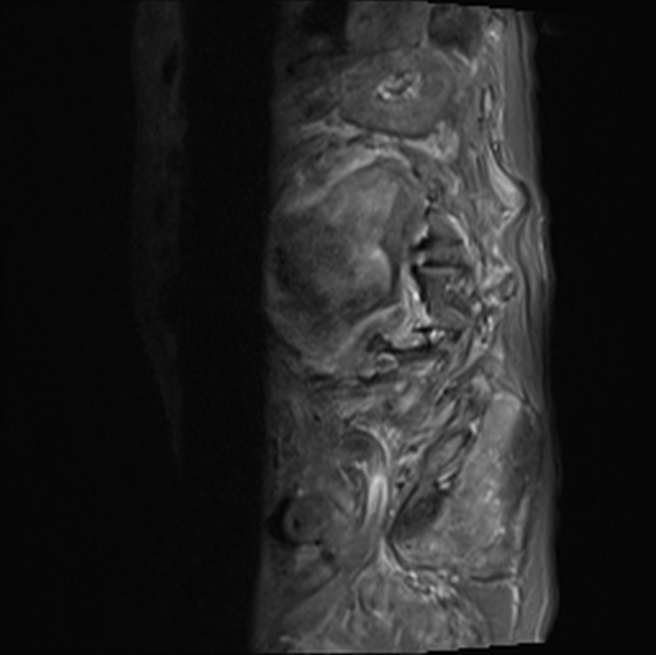 File:Aortic aneurysm with spinal destruction (Radiopaedia 42301-45409 Sagittal T1 fat sat 36).jpg