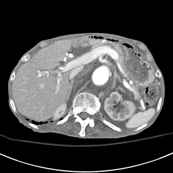 File:Aortic aneurysm with spinal destruction (Radiopaedia 42301-45410 A 25).jpg