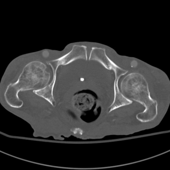 Aortic aneurysm with spinal destruction (Radiopaedia 42301-45410 Axial bone window 110).jpg