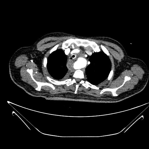 Aortic arch aneurysm (Radiopaedia 84109-99365 B 126).jpg