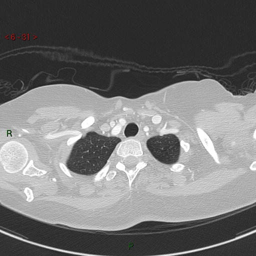 Aortic arch origin of left vertebral artery (Radiopaedia 51520-57286 Axial lung window 31).jpg