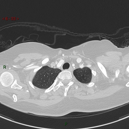 File:Aortic arch origin of left vertebral artery (Radiopaedia 51520-57286 Axial lung window 33).jpg