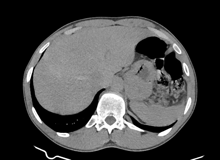 File:Aortic coarctation with aneurysm (Radiopaedia 74818-85828 A 37).jpg