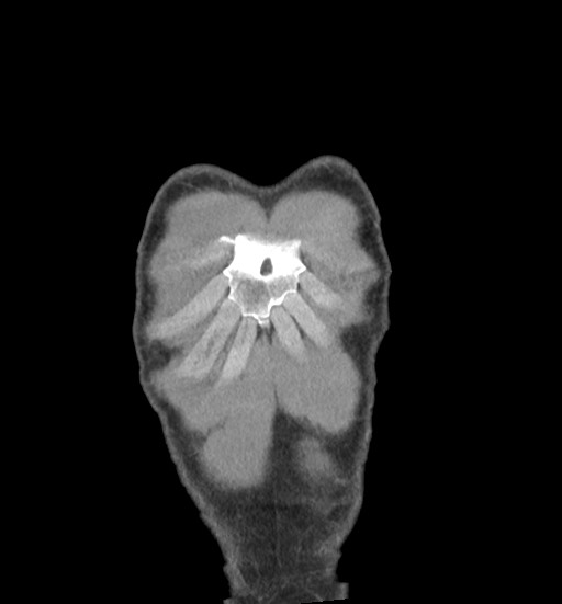 File:Aortic coarctation with aneurysm (Radiopaedia 74818-85828 C 7).jpg