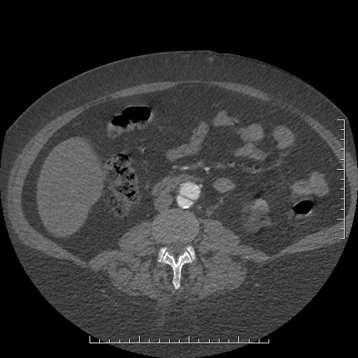 File:Aortic dissection- Stanford A (Radiopaedia 35729-37268 C 20).jpg
