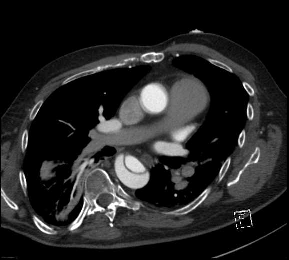 Aortic dissection (CTPA) (Radiopaedia 75506-86750 A 48).jpg