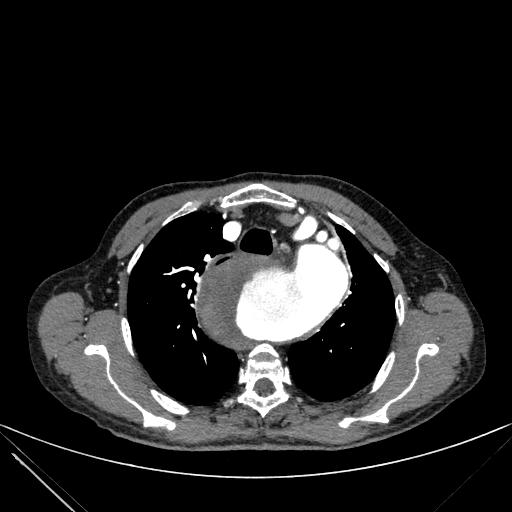 Aortic dissection (Radiopaedia 27466-27665 C+ arterial phase 34).jpg