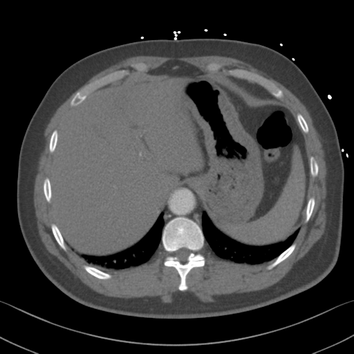 Aortic dissection (Radiopaedia 50763-56234 A 67).png