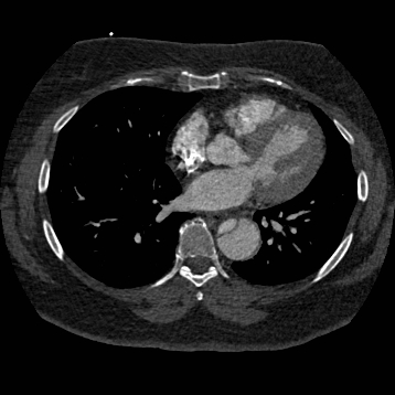 Aortic dissection (Radiopaedia 57969-64959 A 187).jpg