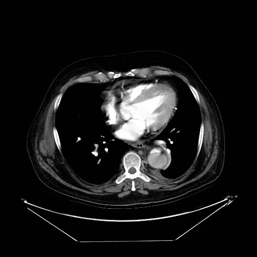 Aortic dissection (Radiopaedia 62562-71000 A 27).jpg