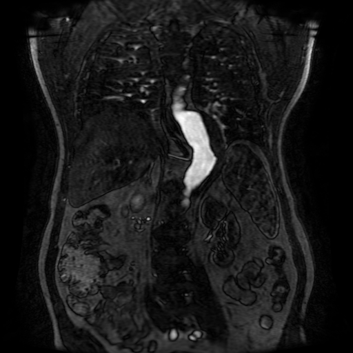File:Aortic dissection - Stanford A - DeBakey I (Radiopaedia 23469-23551 D 160).jpg