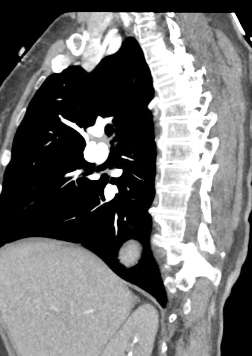 Aortic dissection - Stanford type B (Radiopaedia 50171-55512 C 42).png