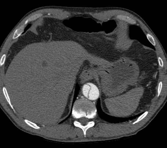 Aortic dissection - Stanford type B (Radiopaedia 73648-84437 A 101).jpg