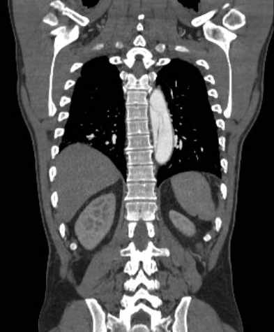 File:Aortic dissection - Stanford type B (Radiopaedia 73648-84437 B 91).jpg
