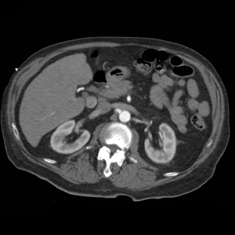 Aortic dissection with rupture into pericardium (Radiopaedia 12384-12647 A 60).jpg