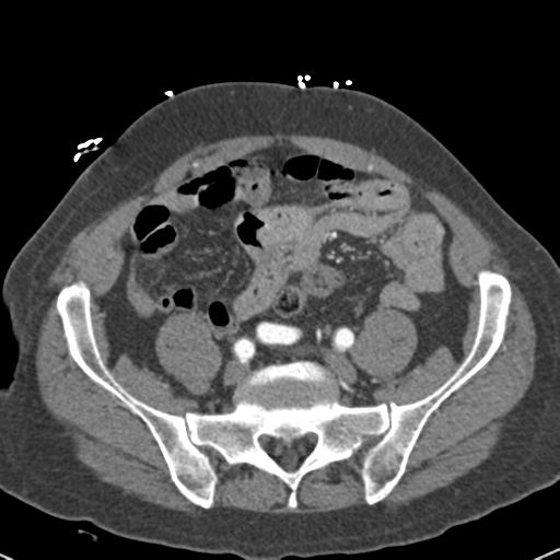 Aortic intramural hematoma (Radiopaedia 31139-31838 B 135).jpg