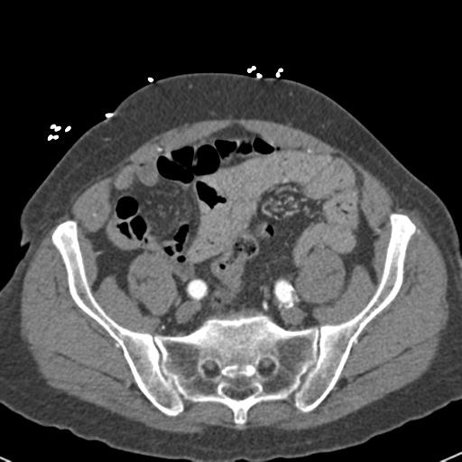 Aortic intramural hematoma (Radiopaedia 31139-31838 B 139).jpg