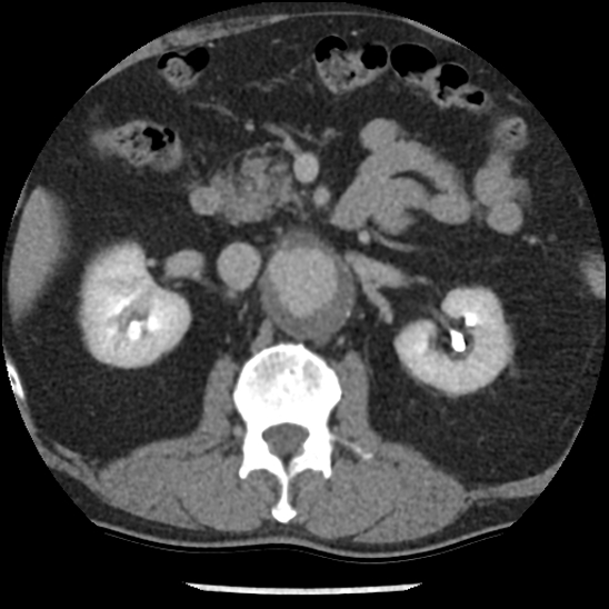 Aortic intramural hematoma (type B) (Radiopaedia 79323-92387 Axial C+ delayed 66).jpg