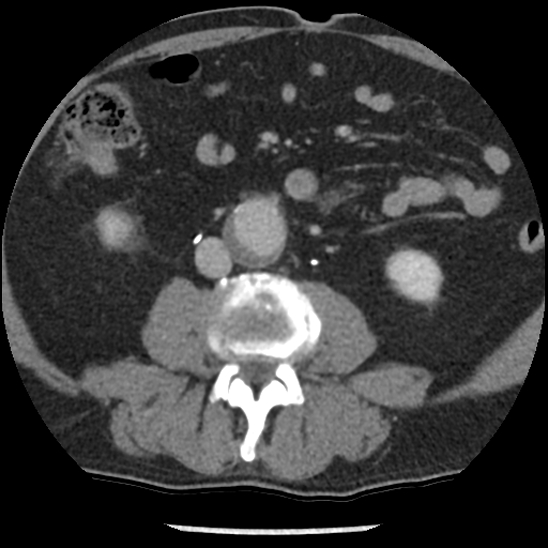 File:Aortic intramural hematoma (type B) (Radiopaedia 79323-92387 Axial C+ delayed 78).jpg