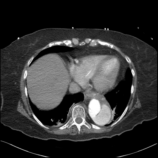 Aortic intramural hematoma with dissection and intramural blood pool (Radiopaedia 77373-89491 B 85).jpg