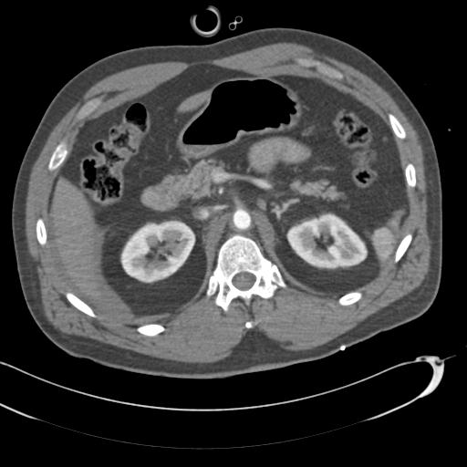 Aortic transection, diaphragmatic rupture and hemoperitoneum in a complex multitrauma patient (Radiopaedia 31701-32622 A 97).jpg