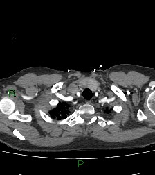 Aortic valve endocarditis (Radiopaedia 87209-103485 C 9).jpg