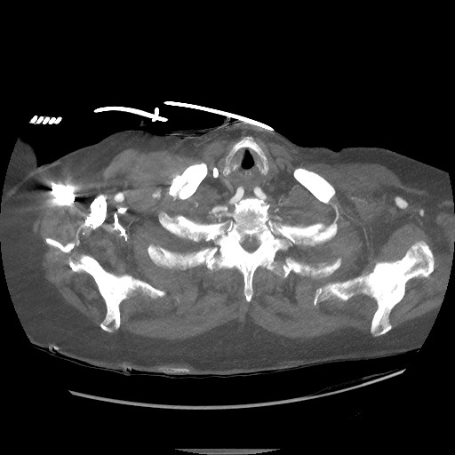 File:Aortoesophageal fistula with endovascular repair (Radiopaedia 73781-84592 Axial 254).jpg
