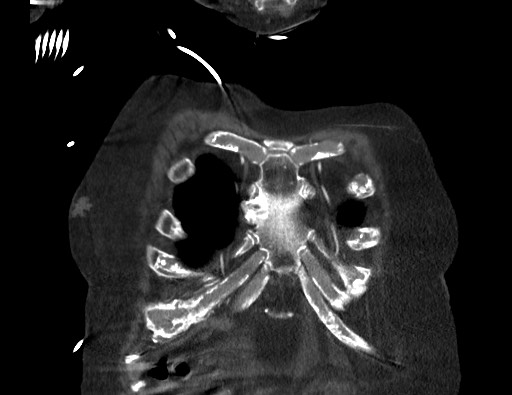 Aortoesophageal fistula with endovascular repair (Radiopaedia 73781-84592 Coronal C+ CTPA 3).jpg