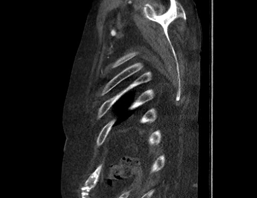 File:Aortoesophageal fistula with endovascular repair (Radiopaedia 73781-84592 Sagittal C+ CTPA 184).jpg