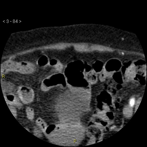Aortoiliac occlusive disease (Radiopaedia 16828-16548 A 84).jpg