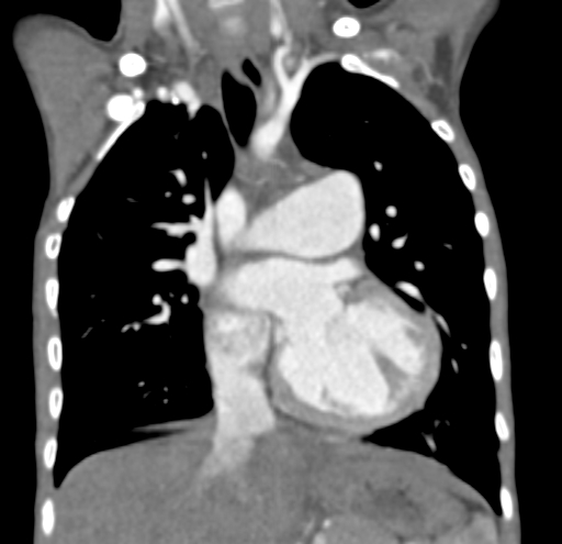 File:Aortopulmonary window, interrupted aortic arch and large PDA giving the descending aorta (Radiopaedia 35573-37074 D 32).jpg