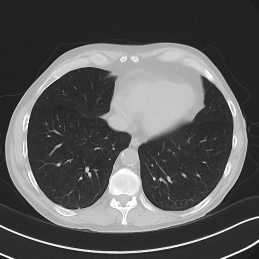 Apical pulmonary metastasis (Radiopaedia 46338-50754 Axial non-contrast 48).png