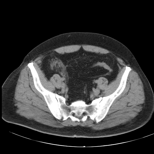 Appendicitis and giant appendicolith (Radiopaedia 80251-93588 Axial non-contrast 46).jpg