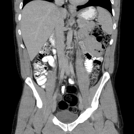 File:Appendicitis complicated by post-operative collection (Radiopaedia 35595-37113 B 27).jpg