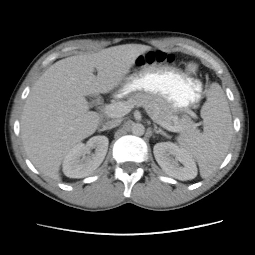 File:Appendicitis complicated by post-operative collection (Radiopaedia 35595-37114 A 26).jpg