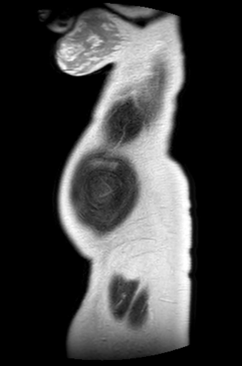 Appendicitis in gravida (MRI) (Radiopaedia 89433-106395 Sagittal T2 4).jpg