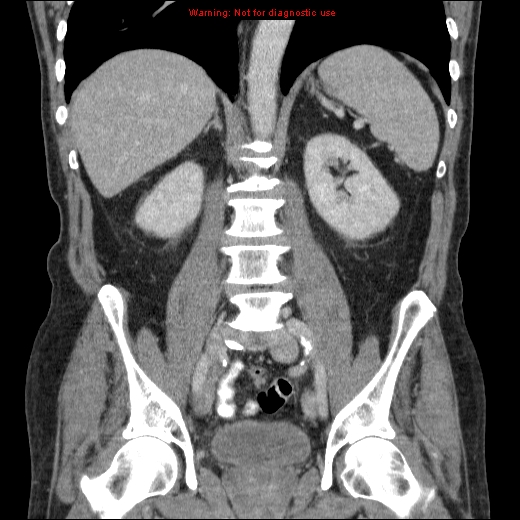 File:Appendicitis mass in inguinal hernia (Radiopaedia 26858-27029 B 47).jpg
