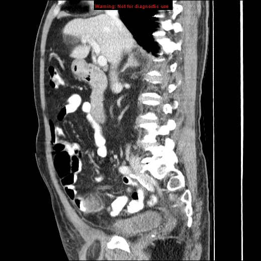 File:Appendicitis mass in inguinal hernia (Radiopaedia 26858-27029 C 22).jpg