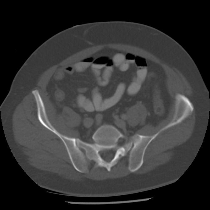 Appendicitis with perforation (Radiopaedia 35790-37342 Axial bone window 39).jpg