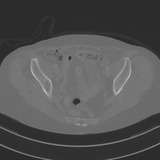 April fools' 2019- calcified peritoneal arachnoidosis (Radiopaedia 67273-76636 Axial bone window 45).png