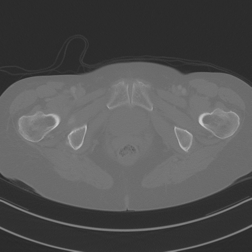 April fools' 2019- calcified peritoneal arachnoidosis (Radiopaedia 67273-76636 Axial bone window 60).png